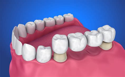 dental bridgr
